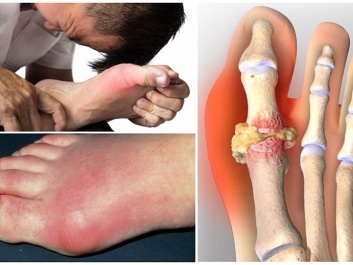 Dấu hiệu nhận biết, cách điều trị bệnh gout hiệu quả